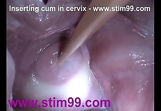 Wraparound goo cum at hand cervix relative to flourishing slit reflector